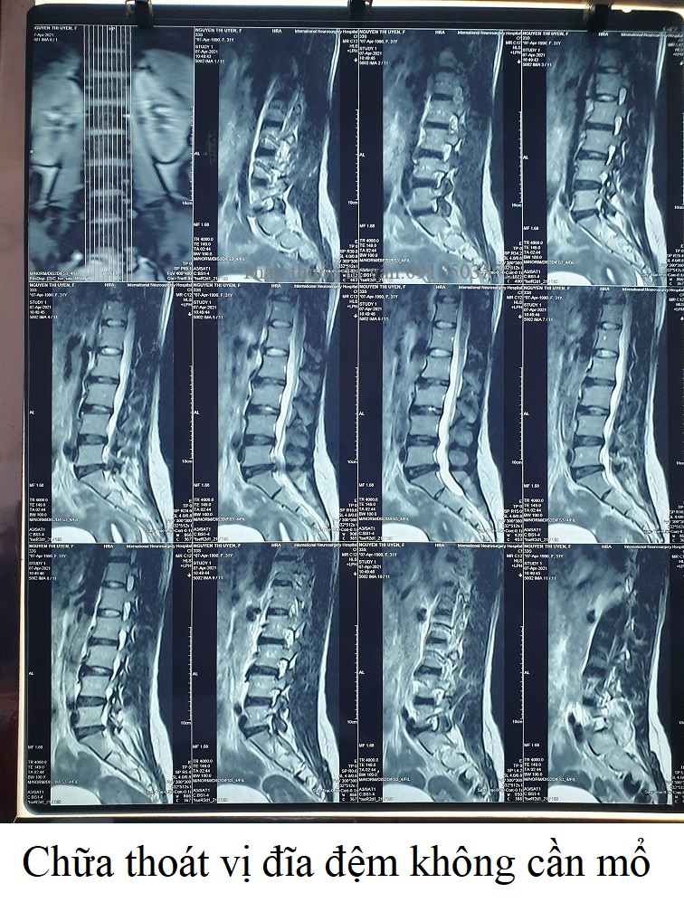 Chữa thoát vị đĩa đệm không cần mổ